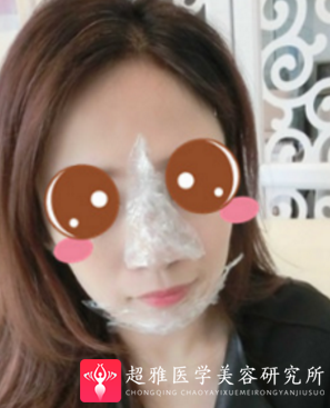 下巴延长术