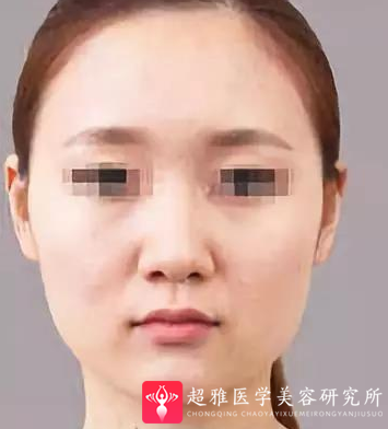 面部提升术