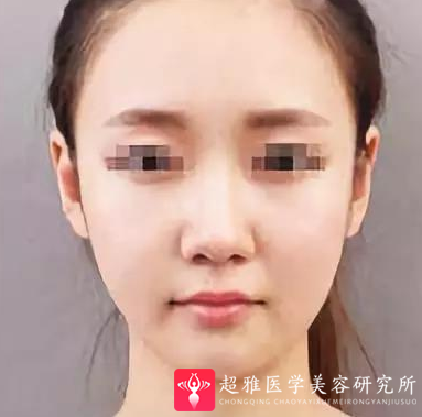 面部提升术