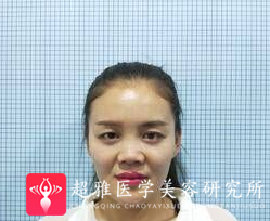 鼻综合整形术