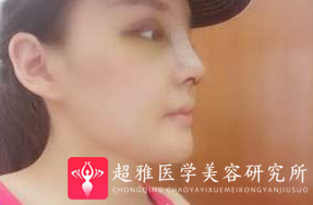 鼻综合整形术