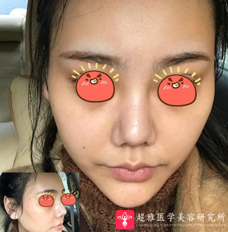 自体脂肪填充