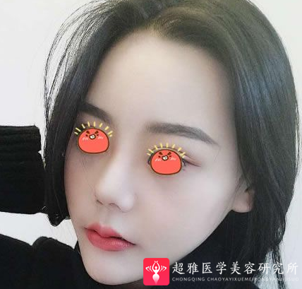 自体脂肪填充