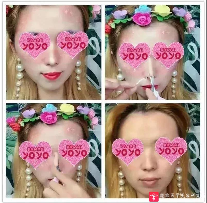 鼻综合整形术