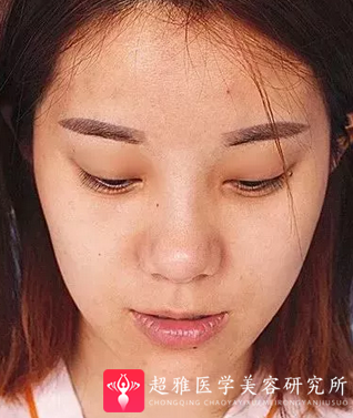 鼻综合整形术