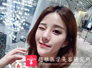 鼻综合整形术