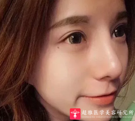 鼻综合整形术