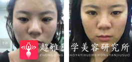 面部提升术