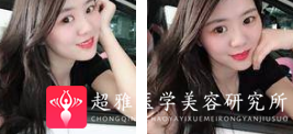 面部提升术