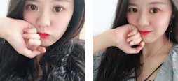 面部提升术