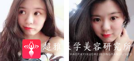 面部提升术