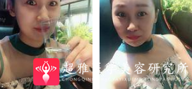 面部提升术