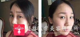 面部提升术