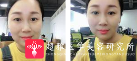 面部提升术