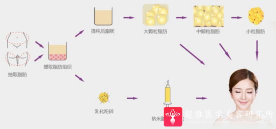 自体脂肪填充