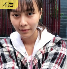 超声波瘦脸