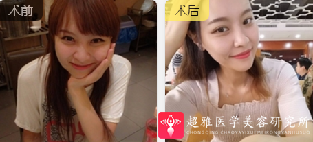 超声波瘦脸