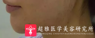 超声波瘦脸