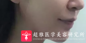 超声波瘦脸