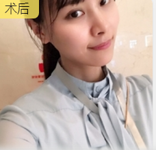 超声波瘦脸