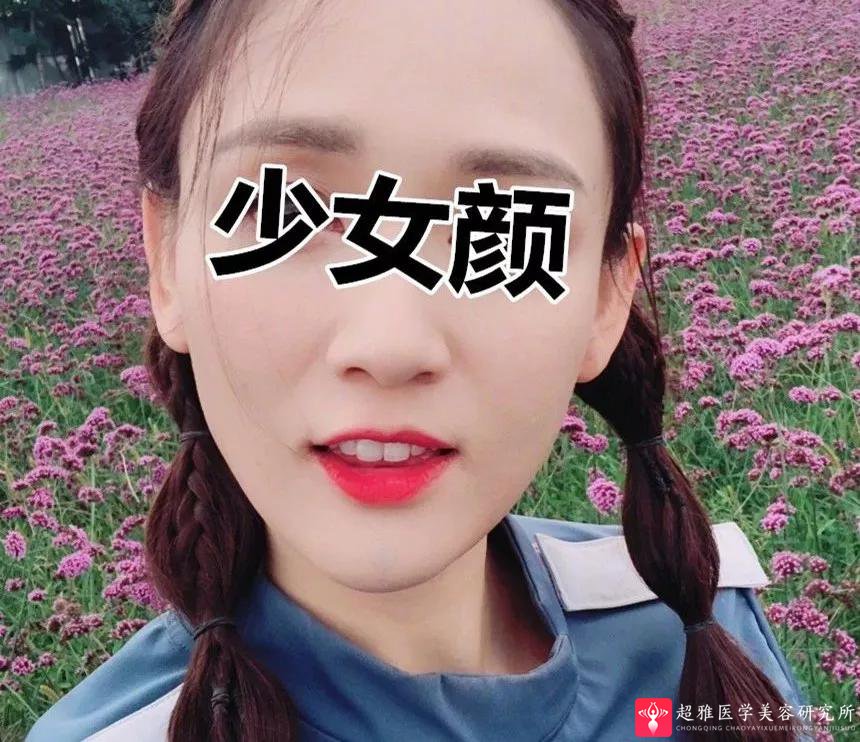 自体脂肪填充