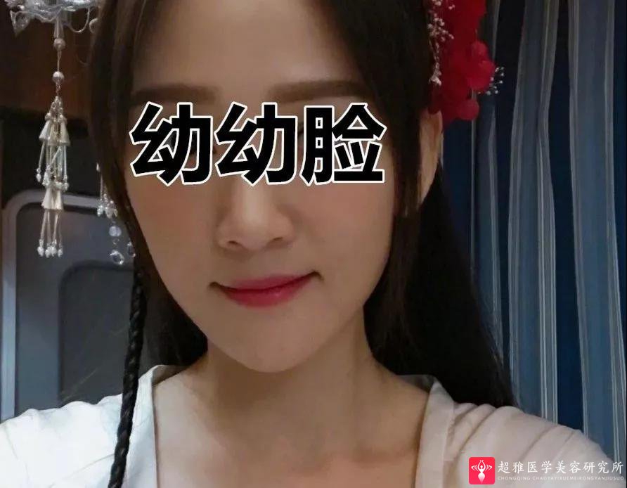 自体脂肪填充