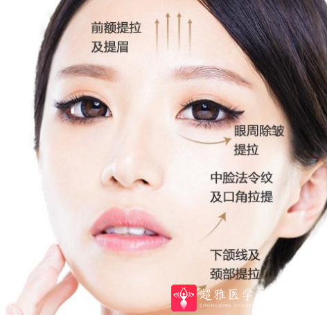 面部提升术