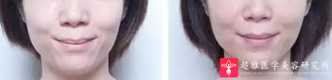 超声波瘦脸