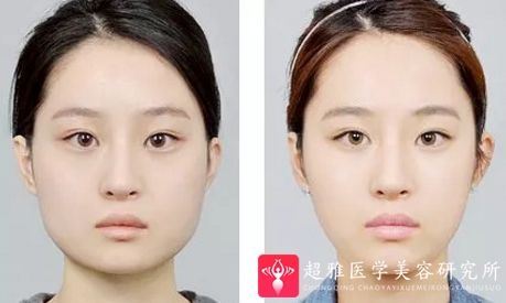瘦脸方法