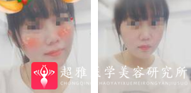 面部提升术