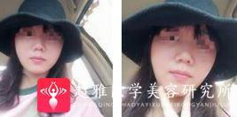 面部提升术