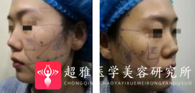 面部提升术