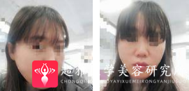 面部提升术