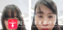 面部提升术