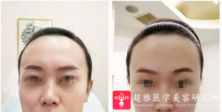 玻尿酸
