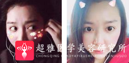 面部提升术