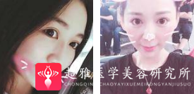 面部提升术