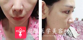 面部提升术