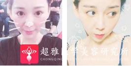 面部提升术