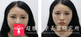 面部提升术