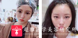 面部提升术