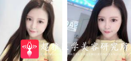 面部提升术