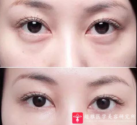 玻尿酸填充术
