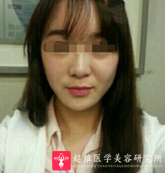 玻尿酸填充术