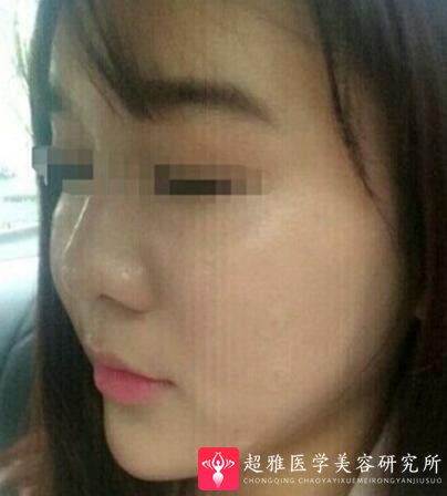 玻尿酸填充术
