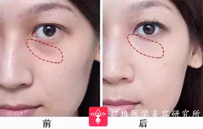 玻尿酸填充术