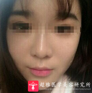 玻尿酸填充术