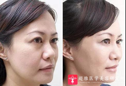 玻尿酸填充术