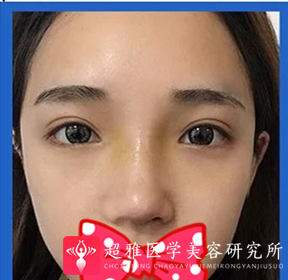 鼻综合整形术