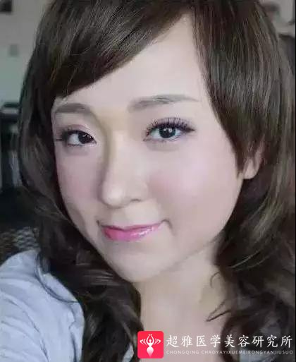 鼻综合整形术